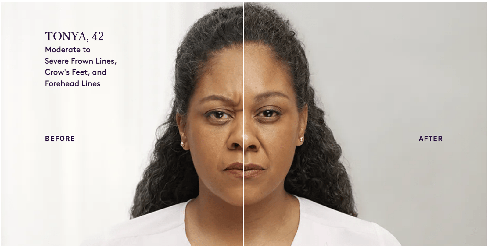 Example of Real Patient Botox Usage Case Link in the Description